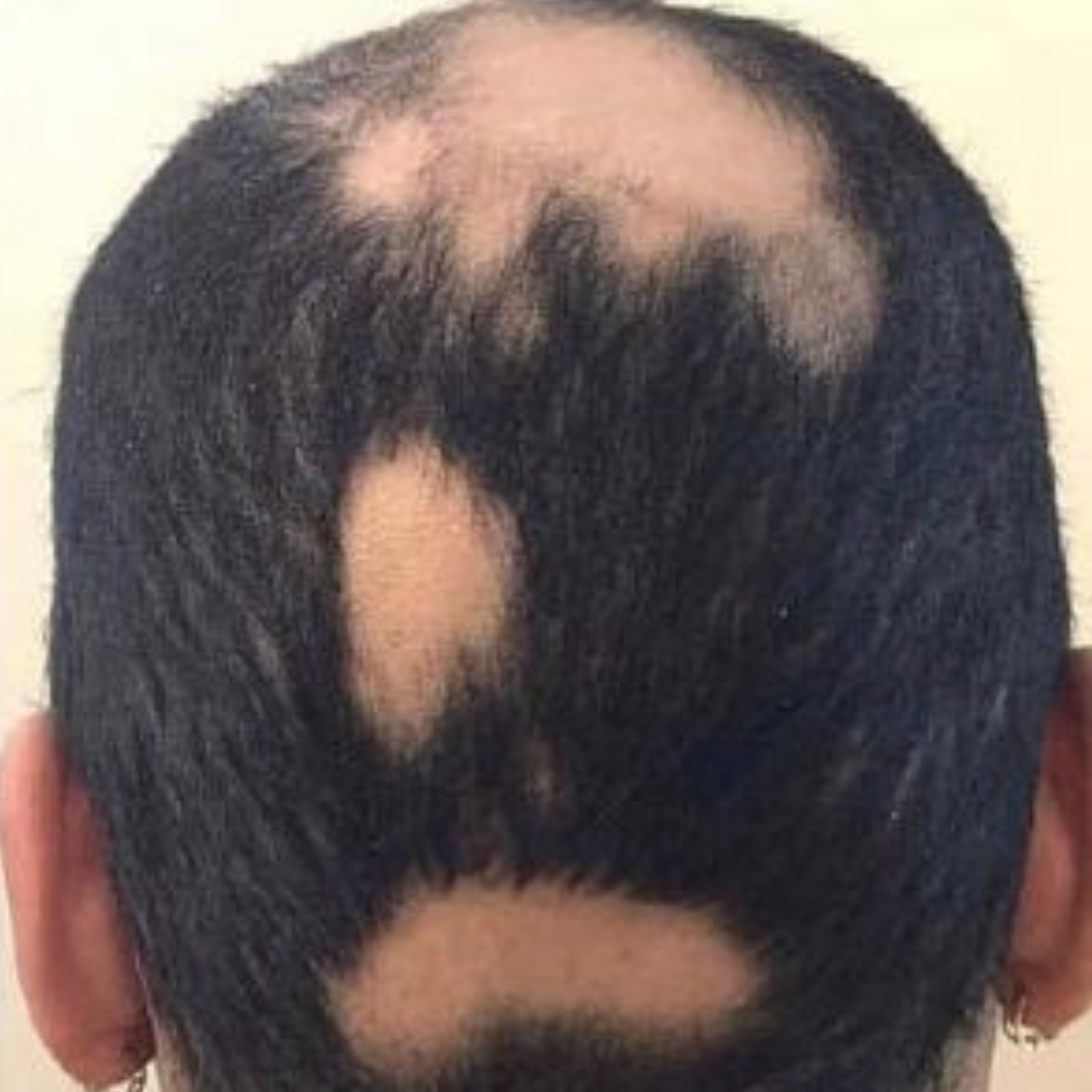 Alopecia behandeling