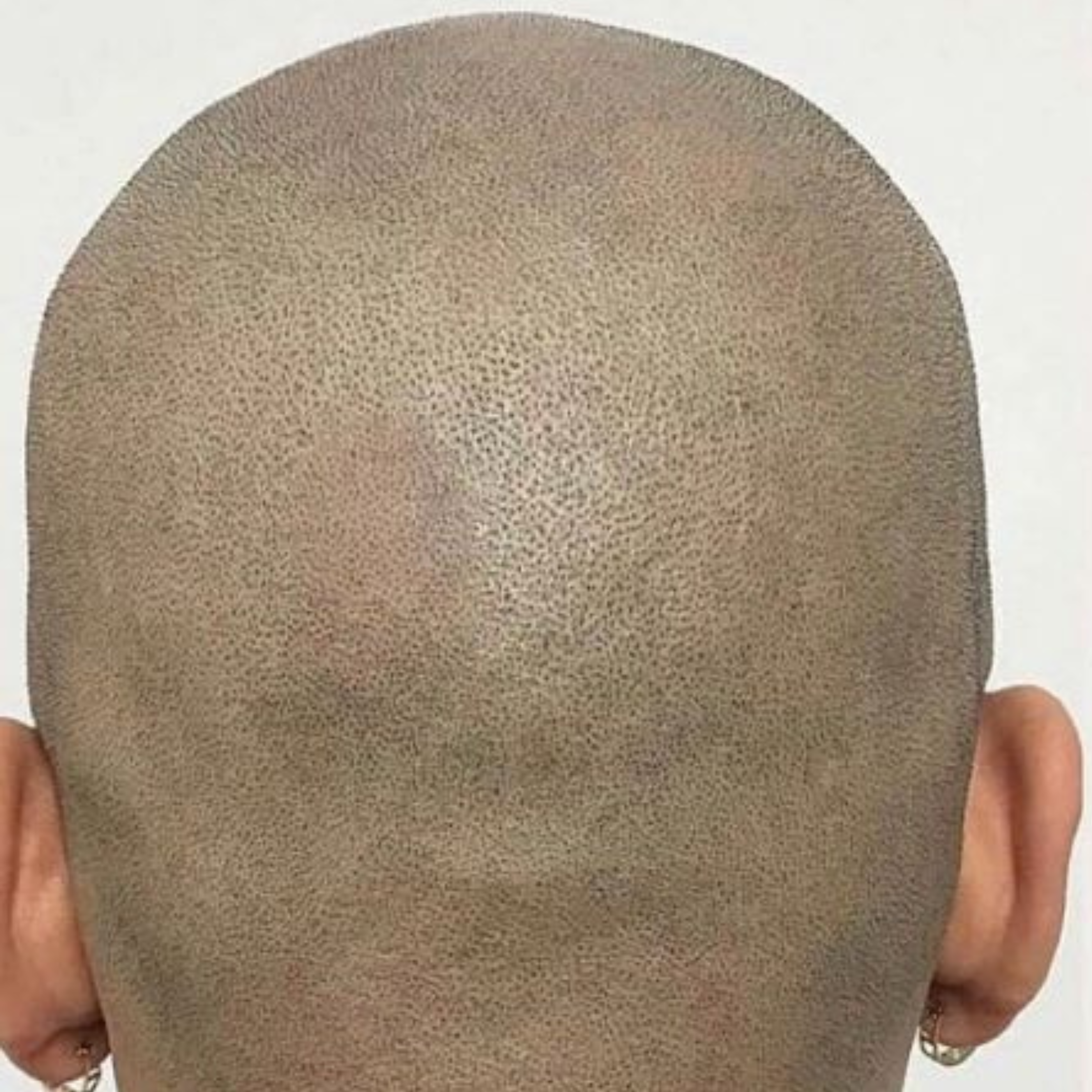 Alopecia behandeling